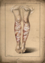 Diseased skin on the legs of a man suffering from psoriasis, 1873. Creator: Christopher D'Alton.