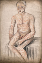 A seated man suffering from a mottled rash of sores, which covers his entire body and face, 1858. Creator: Christopher D'Alton.