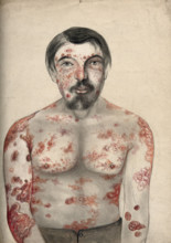 Diseased tissue on the face, shoulders arms and torso of a man suffering from psoriasis..., (18)66. Creator: Christopher D'Alton.
