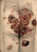 Severely diseased tissue on the buttocks and thighs of a man, 1867. Creator: Christopher D'Alton.