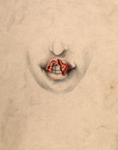Severely diseased tissue on the upper lip of a woman suffering from tertiary syphilis, 1869. Creator: Christopher D'Alton.