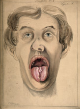 The face of a man suffering from syphilis, shown with mouth open wide, displaying areas of..., 1869. Creator: Christopher D'Alton.
