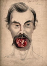 The face of a man suffering from cancer of the tongue, showing severely diseased tissue..., 1867. Creator: Christopher D'Alton.