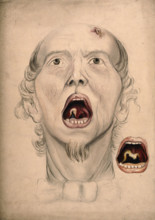 The face of a man, with mouth open wide, displaying a diseased area of tissue on the soft..., 1866. Creator: Christopher D'Alton.