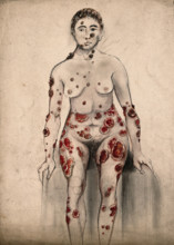 A woman suffering from open sores and abcesses on her face and entire body, 1867. Creator: Christopher D'Alton.