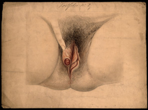 Female genitalia held open by a finger to show an area of diseased tissue, (18)66. Creator: Christopher D'Alton.