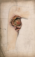 Severely diseased area of tissue on the calf of a woman's leg, (18)58. Creator: Christopher D'Alton.