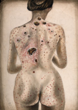 The back, buttocks and arms of a woman, displaying areas of diseased tissue..., (1840/1870?). Creator: Christopher D'Alton.