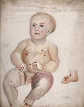 A three month old baby boy with diseased skin and sores on his face and body..., between 1800 & 1899 Creator: Christopher D'Alton.