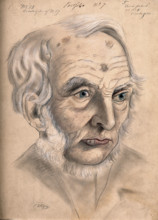 A man suffering from chancre of the lip, displaying scar tissue on his lower lip, forehead..., 1867. Creator: Christopher D'Alton.