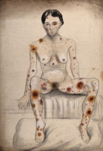A seated woman displaying areas of diseased tissue on her entire body, face, genitals and eye, 1858. Creator: Christopher D'Alton.