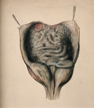 Dissection of diseased intestines, (1851?). Creator: Unknown.