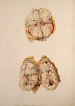 Two diseased parts of the body. Creator: Unknown.