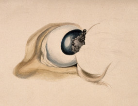 A diseased eye. Creator: Unknown.