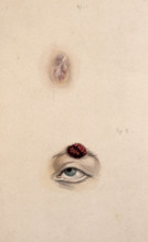 A section of a child's diseased forehead (detail); and a child's diseased eyebrow..., 1829. Creator: Unknown.
