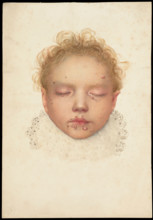 Head of a child with closed eyes and skin disease on the face, 1892. Creator: Unknown.