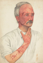 A man with disease designated as Lupus erythematosus, 1902. Creator: Mabel Green.