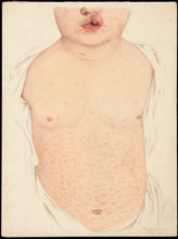 A boy with a congenital deformity of the mouth and a rash on the trunk, Feb 16th 1901. Creator: Mabel Green.