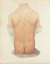 Back of a boy with skin disease, 1891. Creator: W Toogood Hill.