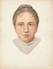 The head of a young woman with loss of skin on her forehead and nose, (1900?). Creator: Jonathan Hutchinson.
