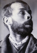 Friern Hospital, London: a man's face showing tuberculosis of the skin (lupus vulgaris), 1890/1910. Creator: Unknown.
