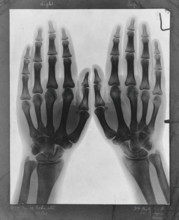 Two hands, viewed through x-ray, 1896.