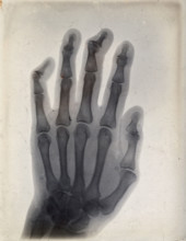 The bones of a hand, viewed through x-ray, 1895.