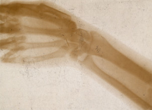 The bones of a hand and wrist, viewed through x-ray, 1896.