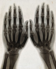 Two hands, viewed through x-ray, 1896.