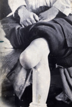 Friern Hospital, London: the knee of a seated person, with a large growth,  1890-1910. Creator: Unknown.