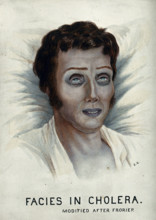 A cholera victim with a typical facial appearance, 1920-1950. Creator: Unknown.