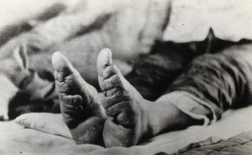 Feet of a Chinese woman, showing the effect of foot-binding, between 1900 and 1999. Creator: Unknown.