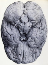 Friern Hospital, London: a brain, 1890-1910. Creator: Unknown.