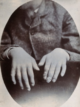 The hands of a child, showing deformity, particularly around the fingertips, c1890s. Creator: N. Goulton May.