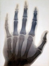 Sir Gervas Powell Glyn, 6th Bart: radiograph of his hand, 1896. Creator: Sir GP Glyn.