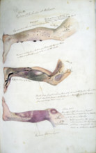 The effects of scurvy, February 1841. Creator: Henry Walsh Mahon.