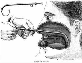 Belloc probe, cannula.Buffering of the nasal cavity
1887  ( Weekly journal by Dr. Gerard in Paris