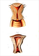 Cavités de l' utérus