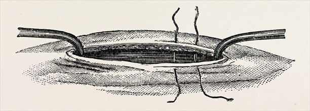 method of steadying the margins of a wound with blunt hooks, medical equipment, surgical