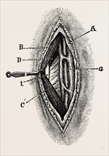 ligatuite of the right radial, medical equipment, surgical instrument, history of medicine