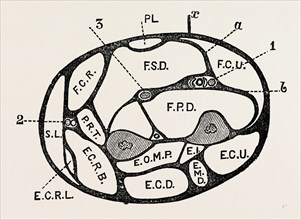 section of the forearm, medical equipment, surgical instrument, history of medicine