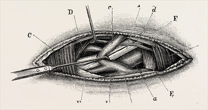 ligature of the right subclavian ernird part, medical equipment, surgical instrument, history of
