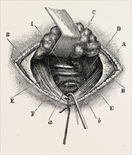 ligature of right lingual artery, medical equipment, surgical instrument, history of medicine