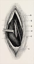 ligature of, femoral are the long saphenous nerve, medical equipment, surgical instrument, history