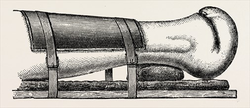 supporting splint adjusted to the leg, medical equipment, surgical instrument, history of medicine