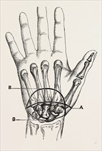 the first incision, palmar incision in the circular, medical equipment, surgical instrument,