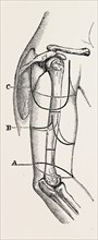 circular (inclined) amputation, medical equipment, surgical instrument, history of medicine