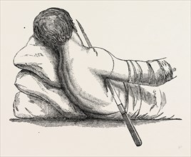 amputation at the shoulder-joint by transfixion, from fergusson's, medical equipment, surgical