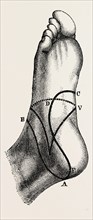 inner and outer sides of the right foot, to show the incisions, medical equipment, surgical