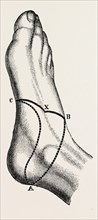 inner and outer sides of the right foot, to show the incisions, medical equipment, surgical